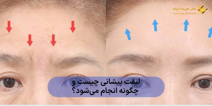 لیفت پیشانی چیست و چگونه انجام میشود؟