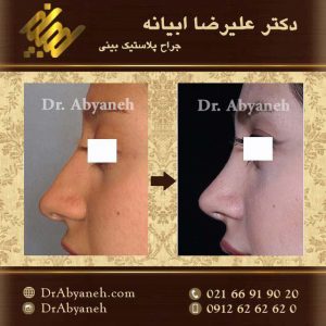 عمل زیبایی بینی