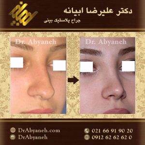 جراحی زیبایی بینی