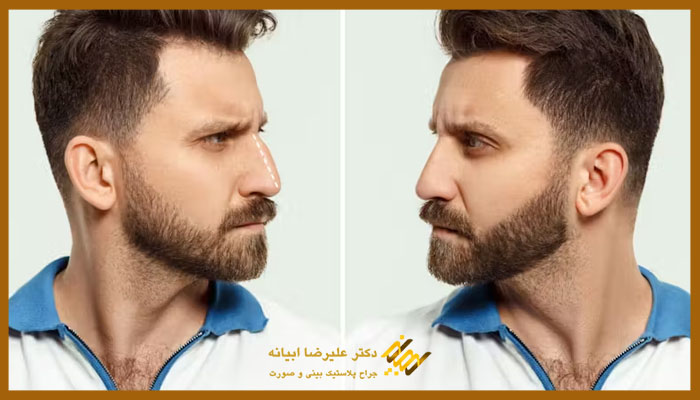 ویژگی های بینی مردانه