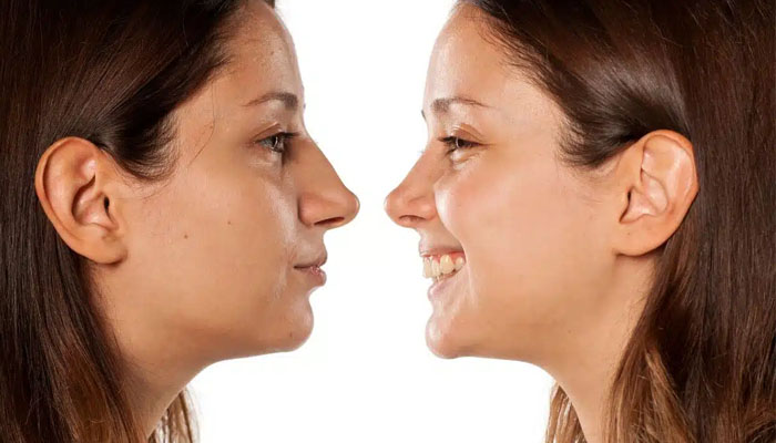 عوارض اصلاح صورت بلافاصله بعد عمل بینی