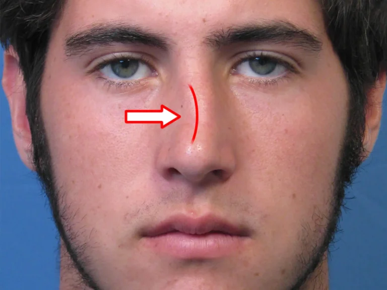 جراحی انحراف بینی کج - دکتر علیرضا ابیانه