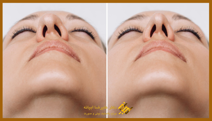 درمان انحراف بینی بدون جراحی