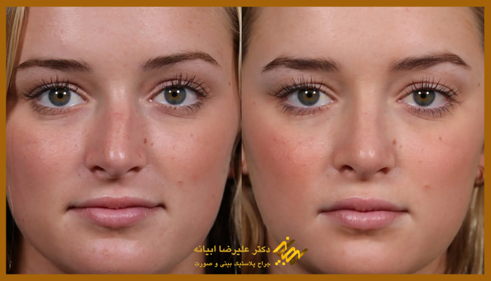 مراحل جراحی بینی کج