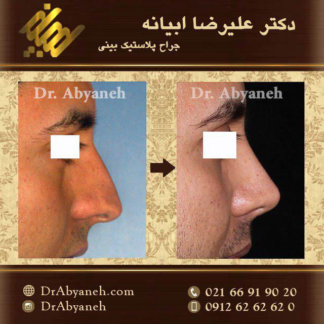 نمونه کار جراحی بینی دکتر علیرضا ابیانه