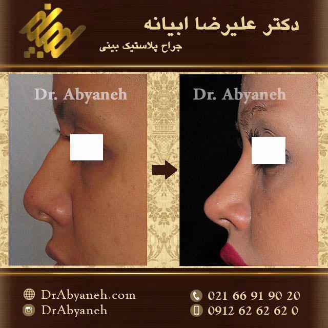 عکس قبل و بعد جراحی بینی دکتر علیرضا ابیانه