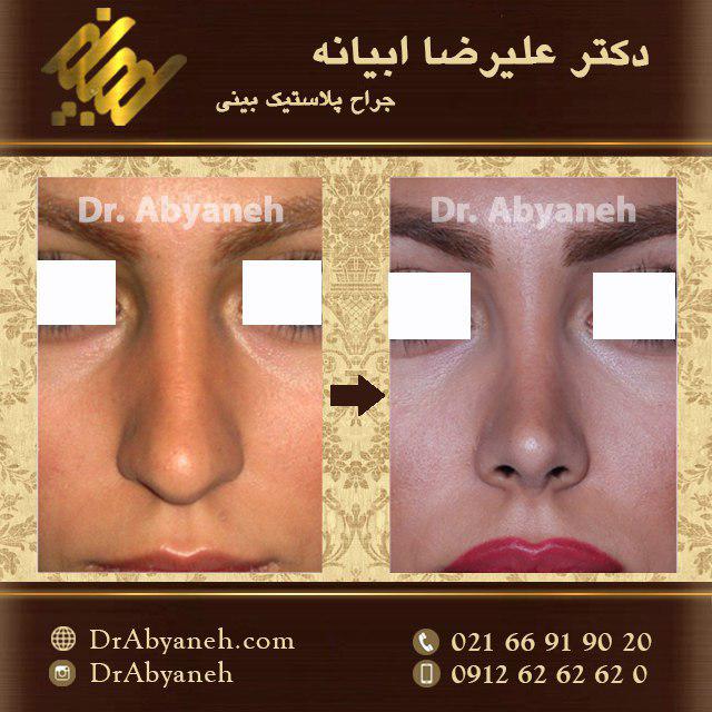 نمونه کار جراحی بینی دکتر ابیانه