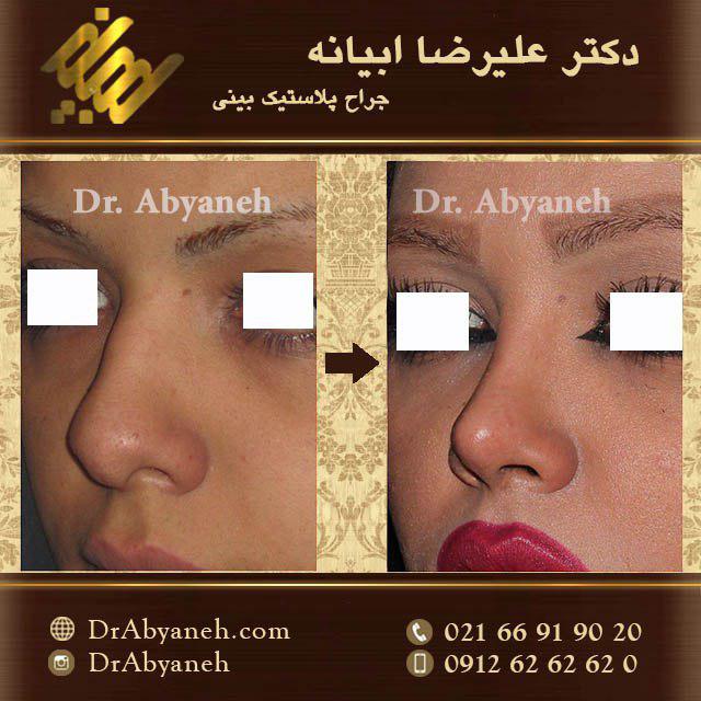 عکس قبل و بعد جراحی زیبایی بینی دکتر ابیانه