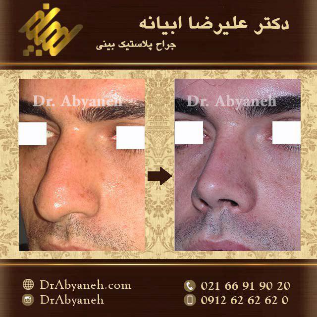 عکس قبل و بعد عمل بینی دکتر ابیانه