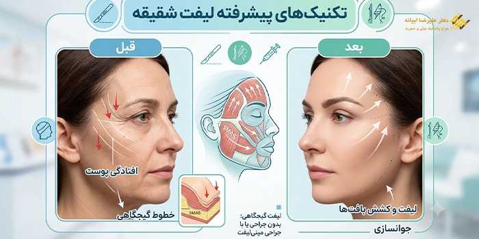 انواع روش های لیفت شقیقه