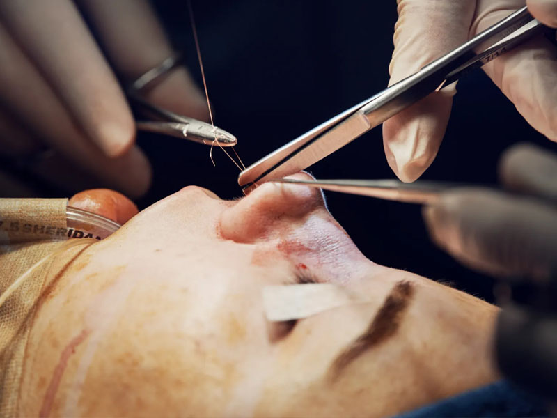 عمل بینی بدون بیهوشی - دکتر علیرضا ابیانه