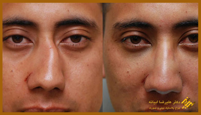 چه زمانی برای شکستگی بینی به پزشک مراجعه کنیم؟