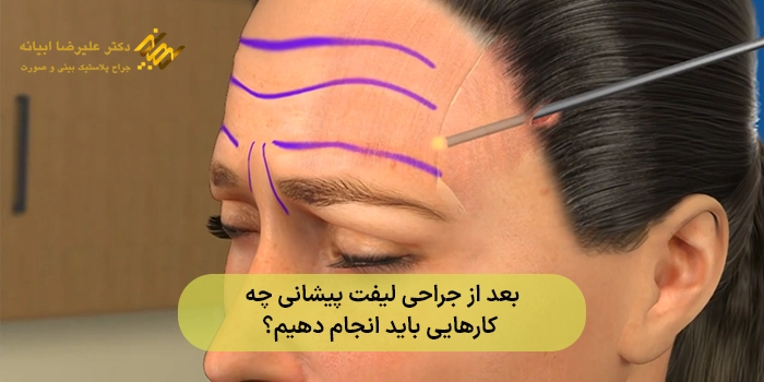 بعد از جراحی لیفت پیشانی چه کارهایی باید انجام دهیم؟