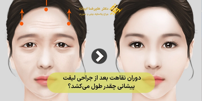 دوران نقاهت بعد از جراحی لیفت پیشانی چقدر طول میکشد؟