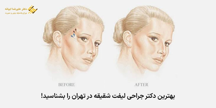 بهترین دکتر جراحی لیفت شقیقه در تهران را بشناسید!