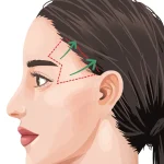 صفر تا 100 لیفت شقیقه و هزینه آن در سال 1404 - دکتر علیرضا ابیانه